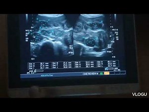 A case of enlarged uterus with multiple fibroids on ultrasound