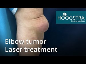 Elbow tumor - Laser treatment (20266)