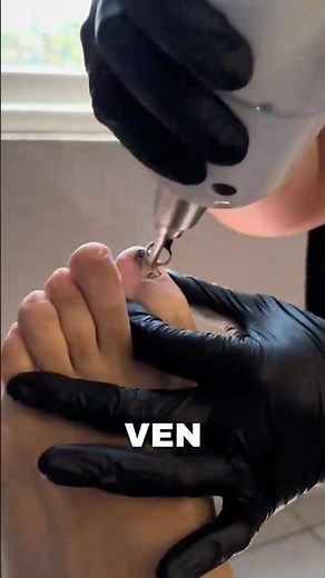 Tratamiento para hongos en las uñas con Láser 3x3