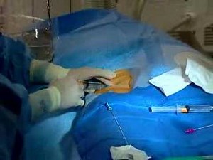 Live Webcast: Cardiac Catheterization, Angioplasty & Stent