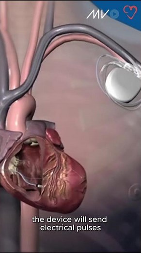 How a Biventricular Pacemaker Helps in Heart Failure Patients