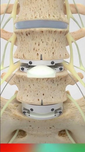 Spine Total Disc Replacement