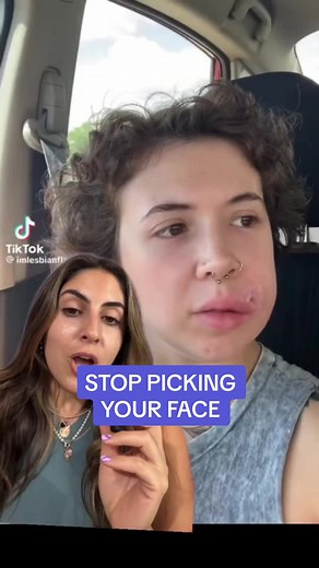 The Dangers of Popping Pimples: Listen to Your Esthetician!