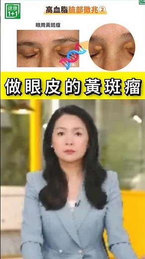 眼皮凸一塊？膽固醇可能超標！看起來像多了一塊脂肪或增生？這可能是常見的眼皮黃斑瘤！有些人的情況只是小小一點，但嚴重時甚至會讓整個上眼瞼看起來腫起來。＃健康1+1 ＃JoJo ＃膽固醇