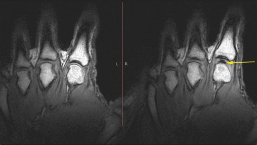 What Is That Horrible Sound When You Crack Your Knuckles?