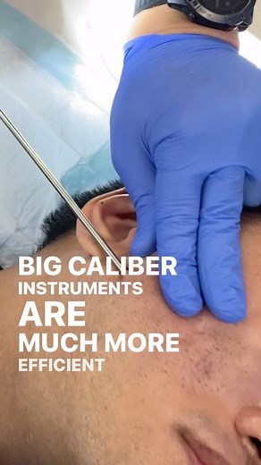 Dr Davin Lim & Dr Van Park on Instagram: "2 possible (though not probable) side effects of aggressive subcision include permanent swelling & facial laxity. Does it permanently cut retaining ligaments? Does it cause long term refractory swelling? How common is it? Is it instrument dependent? Is it technique dependent? What patients are predisposed to this? How to be safer? How to treat it? . 📖Publication one out in Derm Surg early this year, I have 2 more publications coming out (part 2, plus co