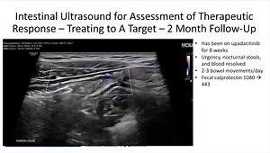 Role of Radiology and Intestinal Ultrasound in IBD