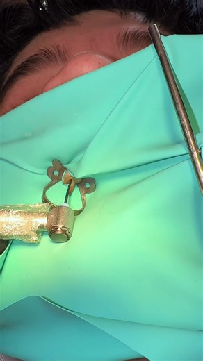 #endodoncia #dentista #endodontics #dental #nervio | dentist