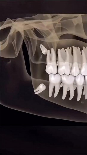 Unerupted or partially erupted Wisdom tooth😯🦷??What are the effects ? #ToothTreat # dental health 💯💯
