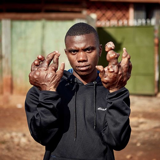 2.3M views · 25K reactions | Harun was born with regular hands, but they soon grew into 'claws' due to Ollier disease | Born Different | Facebook