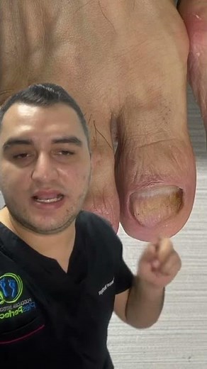 TREATMENT FOR ONYCHOMYCOSIS