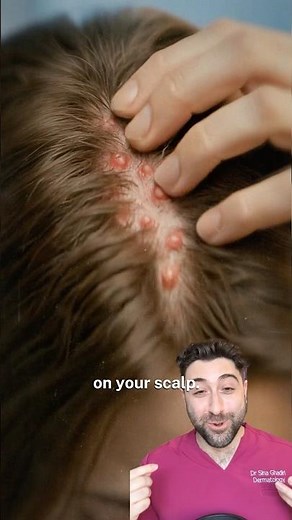 ITCHY SCALP Folliculitis Treatment