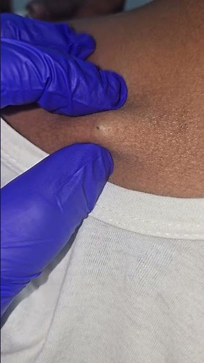 punctum at sebaceous cyst