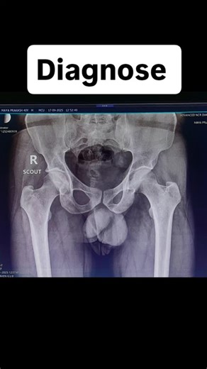 🩺🩺🩺🩺_Radiographer_⚕️⚕️⚕️⚕️ on Instagram: "Micturating Cysto Urethrogram M.C.U"