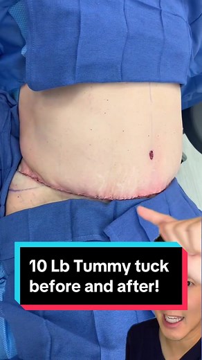 Tummy tuck before and after! I took 10 lbs off her abdomen. Check out her 4 month results! #tummytuckjourney #tummytuck #plasticsurgeon #plasticsurgerybeforeandafter