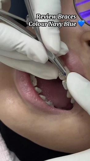 Navy Blue Braces: Best Color for Your Teeth Straightening Journey