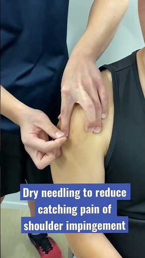Wait for the muscle twitch! Dry needling of lateral deltoid