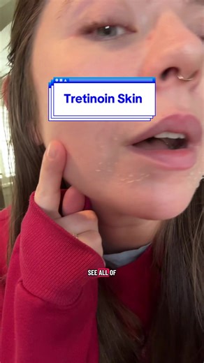 Mi rutina de cuidado de piel con Tretinoína