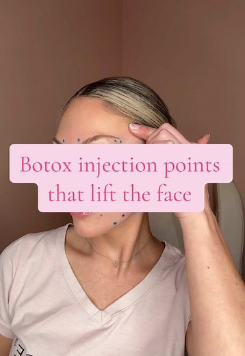 My favorite Botox injection points that give a subtle lift✨🪩🍒 #botox #botoxinjection #botoxfacelift #facelift