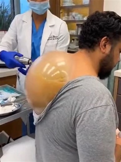 Giant Lipoma Removal: A Satisfying Surgical Experience