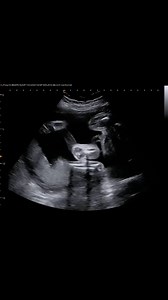 Do You Know The Function Of The Umbilical Cord? Nutrient and Oxygen Delivery:The umbilical cord contains a vein that carries oxygen-rich, nutrient-rich blood from the placenta to the fetus. Waste Removal:It also contains two arteries that carry deoxygenated blood and waste products from the fetus back to the placenta. Connection Point:The cord attaches to the baby's belly button, and the other end is connected to the placenta, which is attached to the uterine wall. #jerbearimaging #umbilicalcord