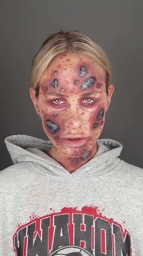 Understanding Marburg Virus: Symptoms, Stages, and Makeup as Deadly Viruses