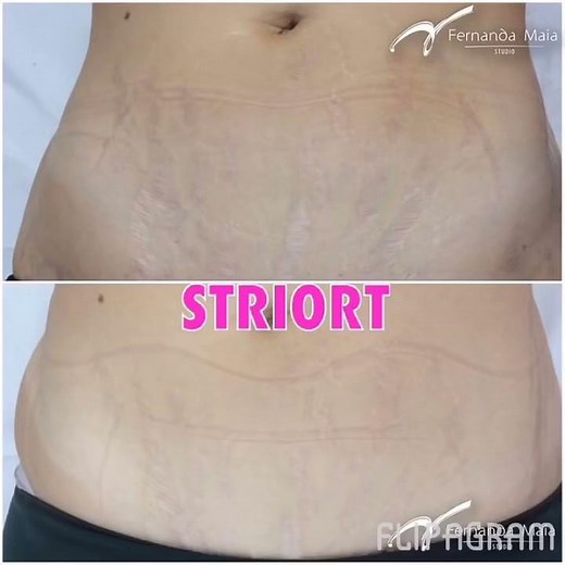 Striort - Tratamento estrias - resultados antes e depois - Fernanda Maia Studio Beleza & Estética