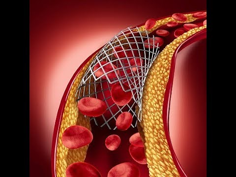 Angioplasty explained!