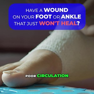 Are you dealing with a wound that just won’t heal? Whether it’s due to poor circulation, high blood sugar, or nutritional deficiencies, your body might need some extra help to recover naturally. At Sheehy Ankle and Foot Center, we specialize in non-healing wound care, providing advanced solutions that not only accelerate healing but also prevent potential complications like infection, pain, and even amputation. This regenerative, anti-inflammatory, and antimicrobial treatment helps your body do 