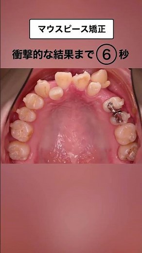 【月額3000円〜／リスク:疼痛等】※詳細は必ず展開してご確認ください•マウスピースを用いた矯正歯科※自由診療/期間・通院回数：6ヶ月〜2年・3〜6回 /施術のリスク: 疼痛、咬合痛、歯根露出等