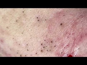 Trifecta of Pops: Relentless Removal—Back-to-Back Blackheads (part 2)