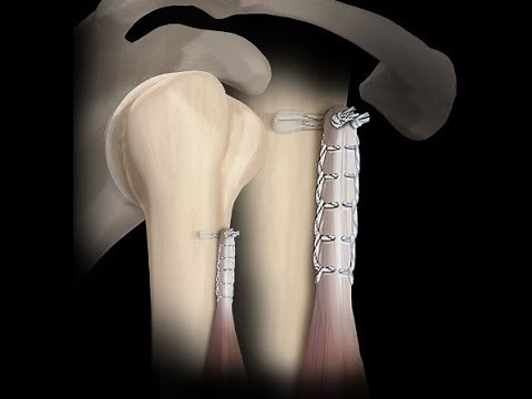 Biceps Tenotomy vs Biceps Tenodesis