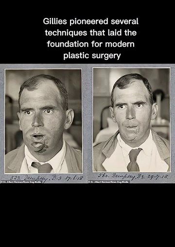 He rebuilt soldiers’ faces & pioneered modern plastic surgery | Dr. Harold Gillies #history