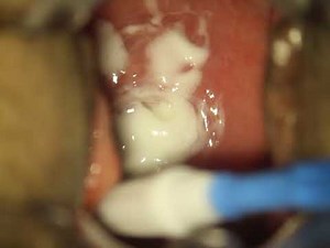 Imiquimod application in the cervix.