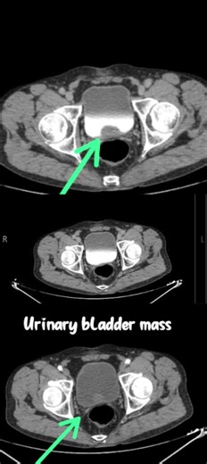 urinary bladder mass. #radiographer #anatomy #radiology #doctor #lifeisbutadream #medicaldiagnosis