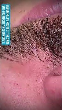 Learning about sebum and acne