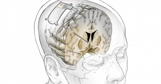 Experimental brain implant zaps away depression in real-time