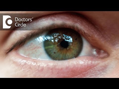 Can moles form in the eye? - Dr. Mala Suresh