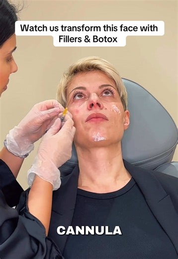 Transforming the Face with Fillers and Botox
