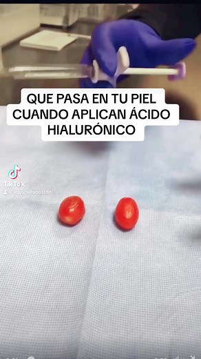 El botox es uno de los tratamientos con más tiempo y más seguros en el ámbito de la estética. Desde hace más de 30 años se comenzó a utilizar con resultados cada vez más naturales. Sin embargo, la falta de conocimientos y la desinformación por parte de los medios han hecho que se generen muchos falsos mitos del botox. Aquí te vamos a decir realmente lo que el Botox hace. #aquabellabyadriana #Botox #rejuvenecimiento #saludybelleza #arrugasenlafrente #aquabellaboston #aquabellamedspa2024 #aquabell