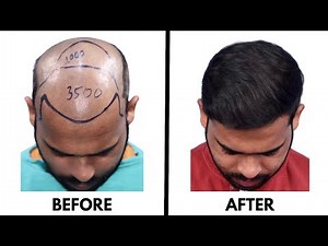 How to get 100% results in Hair Transplant - Doctor explains (Tamil)