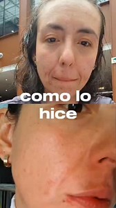 Rutina noche 🌛 Dure mucho tiempo sufriendo con el acné, hasta que encontré esta crema 👉 Zudenina Plus junto a una pequeña rutina, me ayuda a controlarlo, aquí te dejo mis pasos: 1. Limpia tu piel, a mí me ayuda el agua miceral del D1, la uso todas las noches 2. Usa doble limpieza y más si usas maquillaje. Yo lavo mi carita con jabón de cúrcuma, lo amo. 3. Zudenina Plus, el uso al principio es paulatino, yo inicie tres veces a la semana y luego fui aumentando el uso según reaccionaba mi piel, h