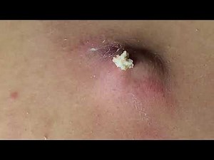 How Much Can This Cyst Give?