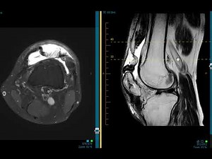 Quadriceps tendon re-tear