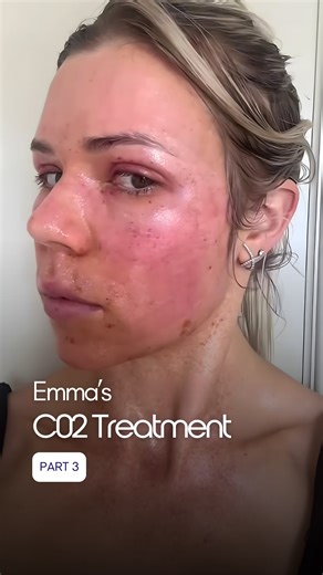 301 reactions · 12 shares | Recovery from CO₂ laser treatment is a gradual process that typically unfolds over several days. Redness, mild swelling, and flaking are all part of your skin’s natural renewal phase as new, healthy skin cells begin to surface. | Contour Clinics | Facebook