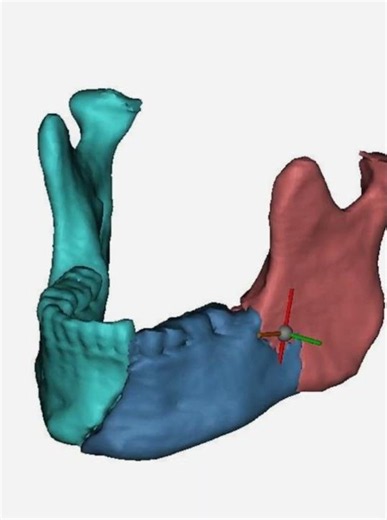 OMFS Case: Mandibular Fracture Reduction &Internal Fixation #shorts#OralSurgery#MaxillofacialSurgery