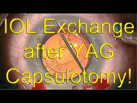 IOL exchange surgery (with open capsule after YAG capsulotomy) - Dr Simon Chen