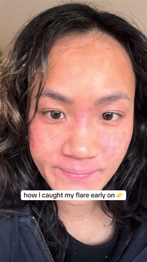 I track my symptoms so I can see why I flared that day. It empowers me and gives me confidence to make better decisions and manage eczema. I also don’t spiral into anxiety trying to find a quick fix solution, I trust myself more and know that my body is doing what it can to heal. #eczemaflareup #eczemahealing #sensitiveskin #TSW #winterskincare