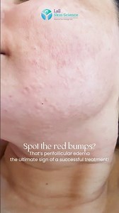 Red Bumps After Laser Hair Removal? Don't Panic!