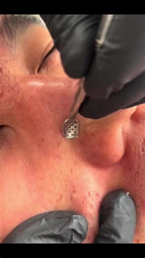 Pore Extraction Process: A Close-Up View